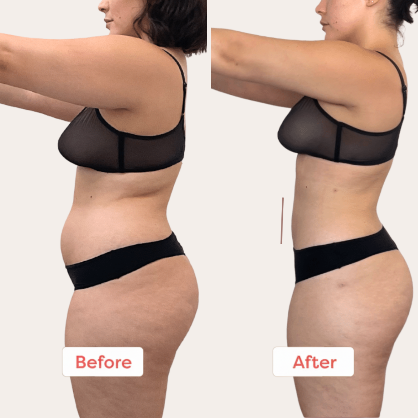 SculptCura™ Body Sculpt